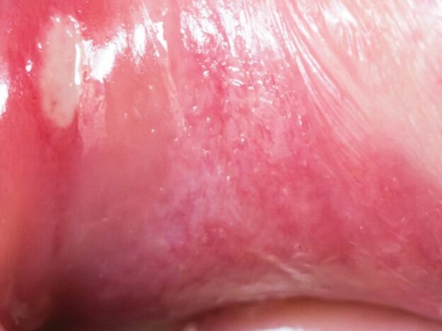 Common Ulcerations of the Oral Cavity course image