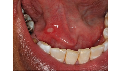 aphthous ulcers tongue