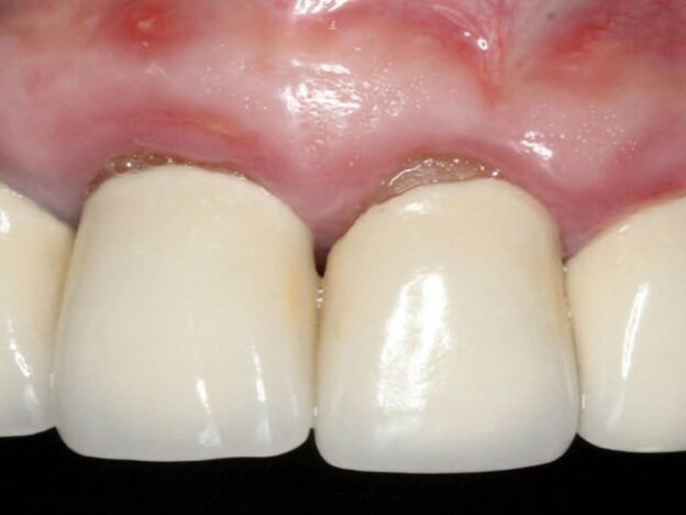 Using d-PTFE Barriers to Enhance Bone and Soft Tissue Regeneration course image