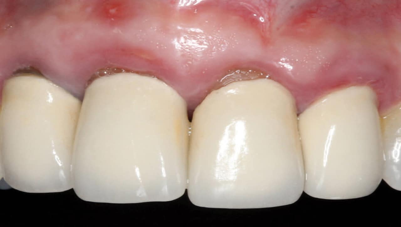 Using d-PTFE Barriers to Enhance Bone and Soft Tissue Regeneration -  Decisions in Dentistry