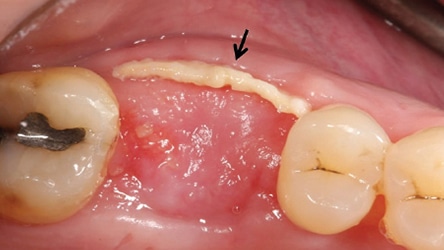 granulation tissue tooth extraction