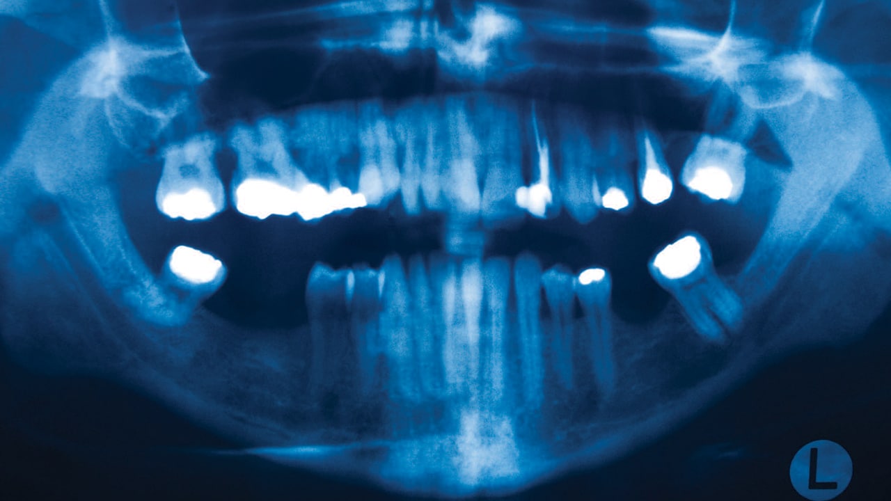 Five Misconceptions in Endodontics - Decisions in Dentistry