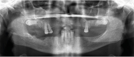 Investigation of the Electric Handpiece-related Pneumomediastinum and  Cervicofacial Subcutaneous Emphysema in Third Molar Surgery