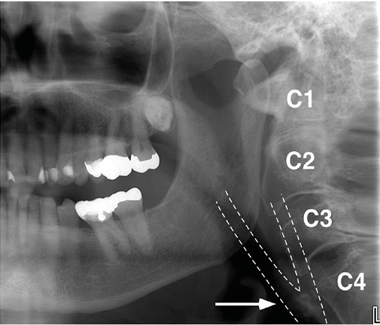 Identifying Carotid Artery Atheromas on Pantomographs - Decisions in ...