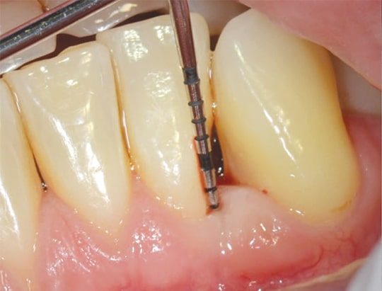 Strategies for Periodontal Risk Assessment and Prognosis - Decisions in ...