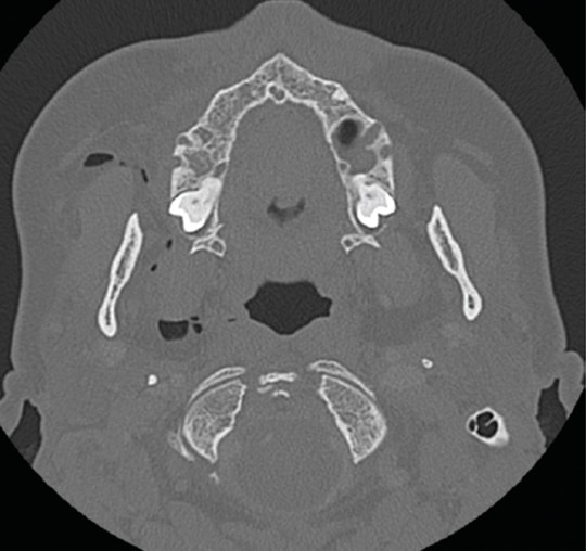 Investigation of the Electric Handpiece-related Pneumomediastinum and  Cervicofacial Subcutaneous Emphysema in Third Molar Surgery