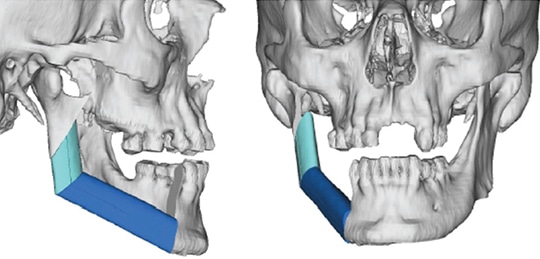 Gingival Cancer Overview For General Practitioners Decisions In Dentistry 