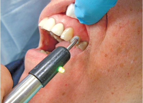 Pain Management In Endodontic Treatment Decisions In Dentistry