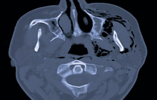 Managing Subcutaneous Emphysema Following Dental Procedures course image