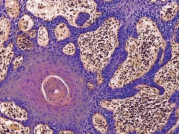 Gingival Cancer Overview for General Practitioners course image