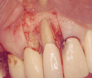 Isolated deep pocket associated with vertical root fracture and