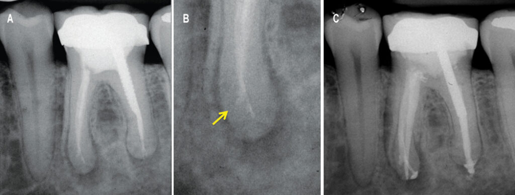 Approaches to Nonsurgical Root Canal Retreatment