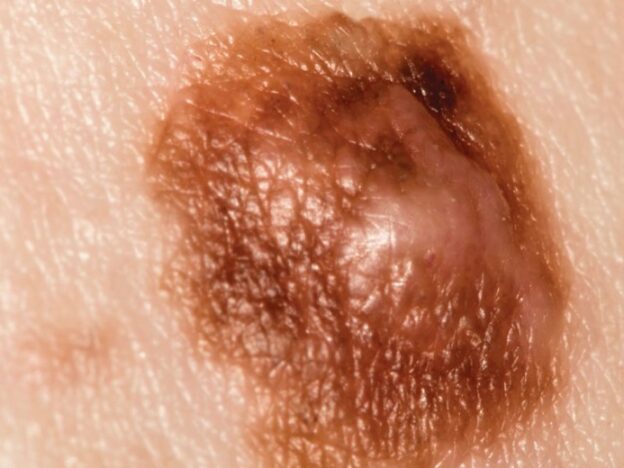 Screening for Skin Cancer course image