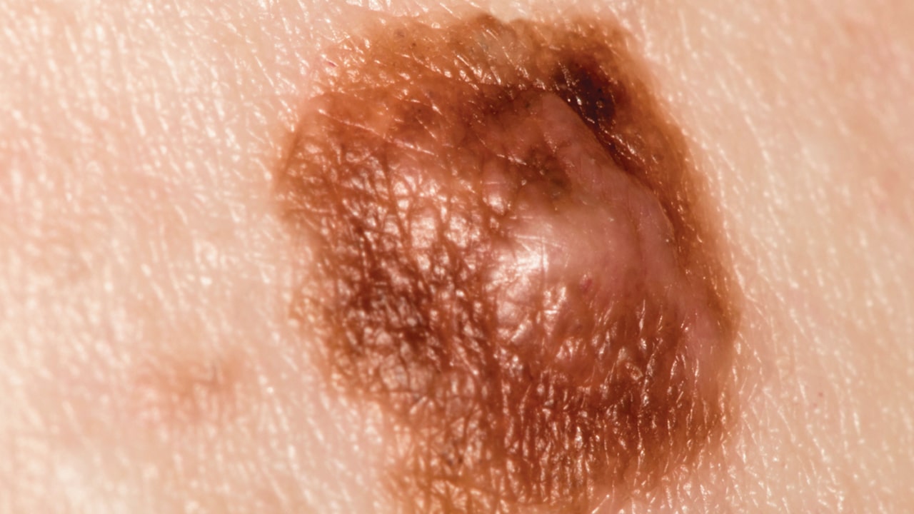 Screening For Skin Cancer