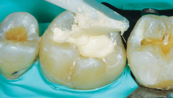 Examining Bioactive Restorative Materials
