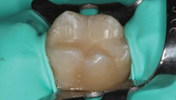 Examining Bioactive Restorative Materials