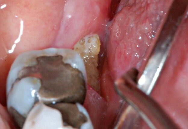 Oral Health Implications of Antiresorptive Medications course image