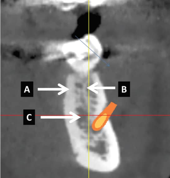 Alveolar Bone And Implant Therapy