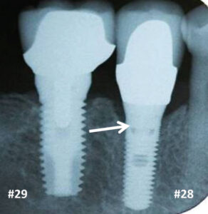 alveolar bone loss