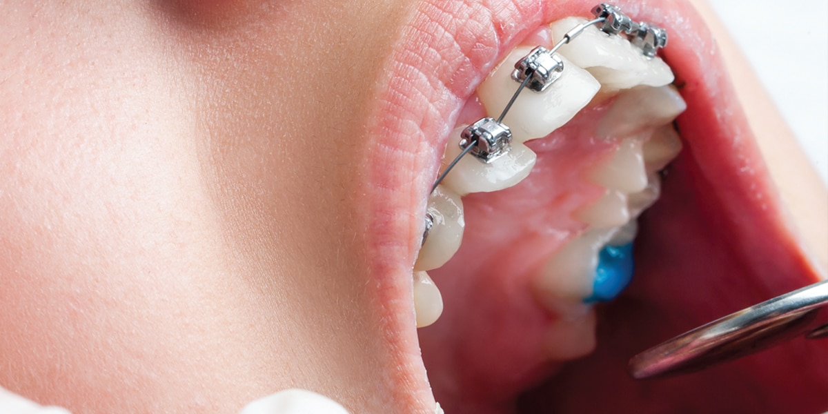 5 Types of Dental Braces - TM Dental Solution