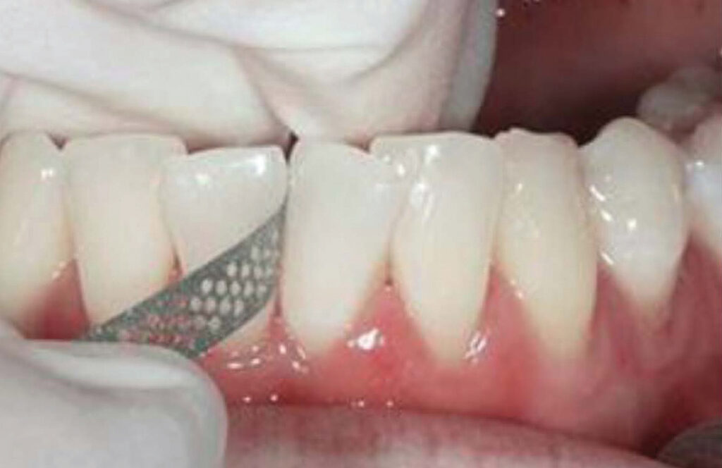 Hypersensitivity in Orthodontic Treatment