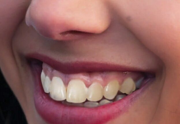 Decision Making in Managing Excess Gingival Display course image