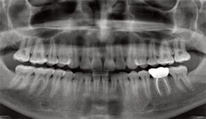 inferior alveolar nerve panoramic