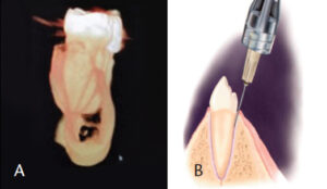 Inferior Alveolar Injection Approach