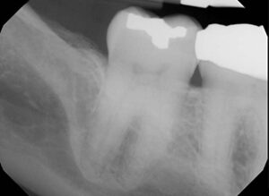 Inferior alveolar approach 