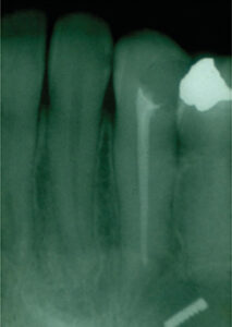 Third Molar Patient