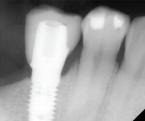 Digital Dentistry Implant Site