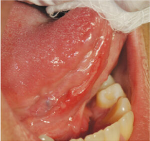 Behçet’s Disease 4