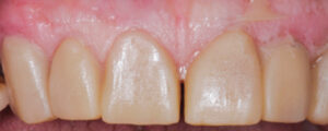 Esthetics Maxillary View