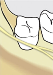 Third Molar Area 