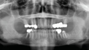 Third Molar Extraction 