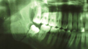 Third Molar Site