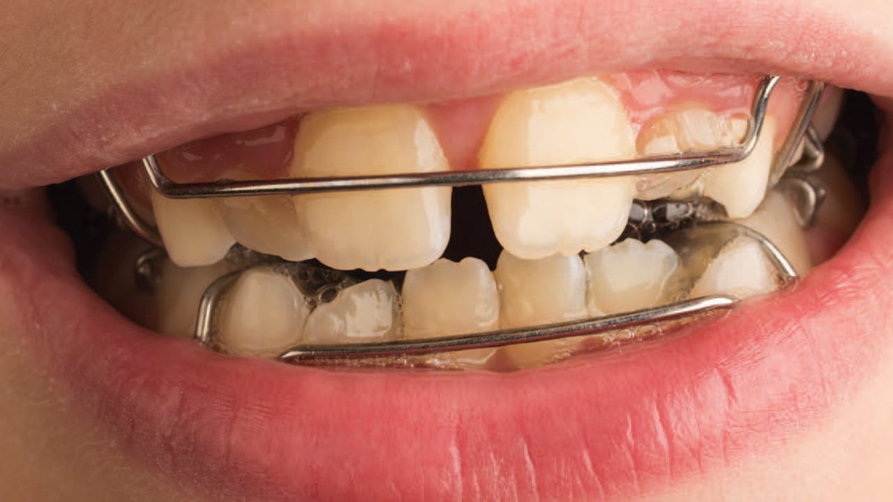 Cross-elastics to assist in expansion of the maxillary arch.