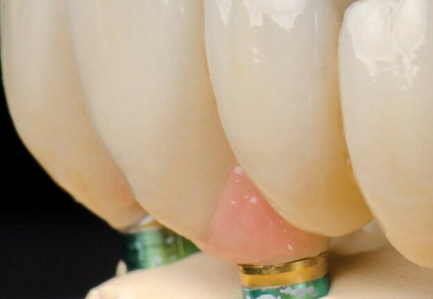 Collaborative Management of Anterior Esthetics in an Implant Patient course image