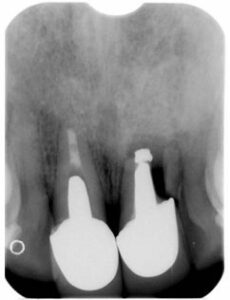 Anterior Teeth