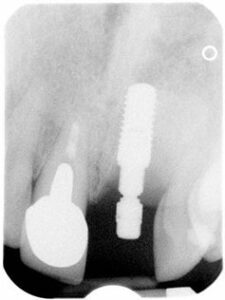 Anterior Teeth Bone Level