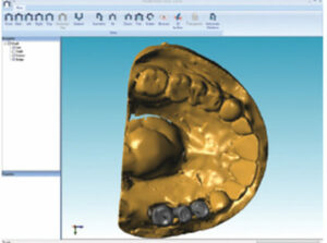 Digital Fabrication Implant