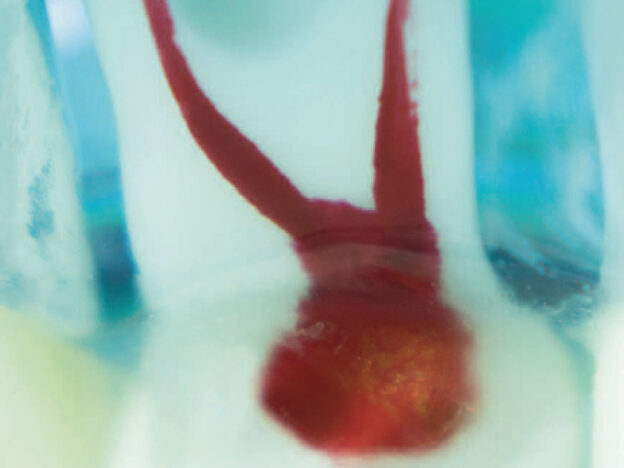 Cleaning and Disinfection in Root Canal Treatment course image
