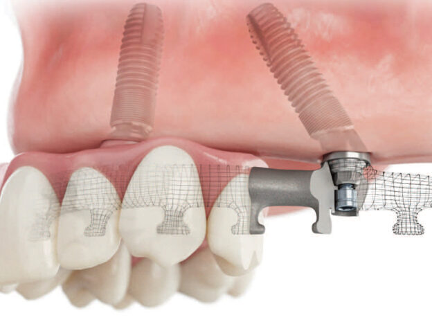 Dental Implant Treatment for Totally Edentulous Patients course image
