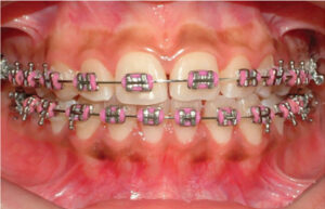 Free Gingival Graft Pateint