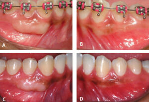 Fee Gingival Graft technique