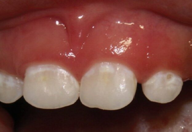 Pathways for the Management of Early Childhood Caries course image