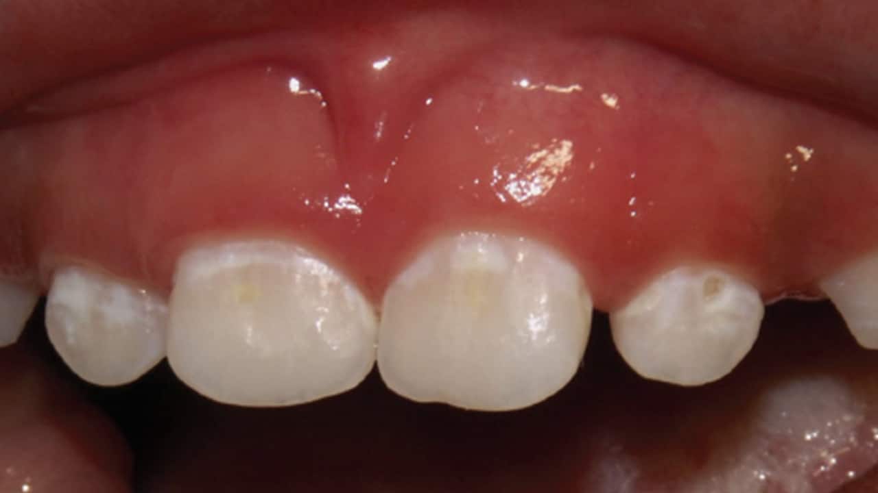 https://decisionsindentistry.com/wp-content/uploads/2018/10/caries-featured.jpg