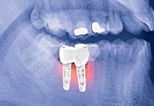 Use of Metal-titanate Nanoparticles to Combat Peri-implantitis course image