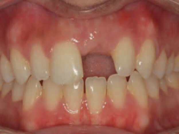 Guided Dental Implant Placement and Immediate Temporization course image