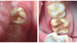 Severe molar incisor hypomineralization